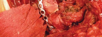 Illustration 47 for Navigating Early THA for Fractures of the Acetabulum