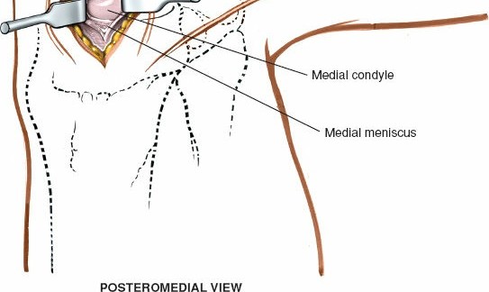 Illustration 62 for Mastering Knee Approaches: Spotlight on Superficial Medial Ligament