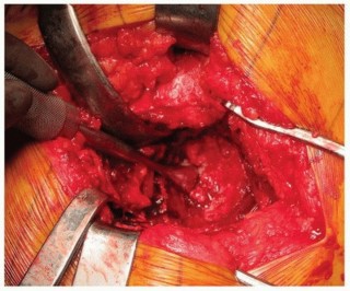 Illustration 17 for Uncemented Acetabular Revision: Optimizing Hemispherical Cup Use