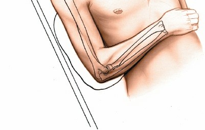 Illustration 2 for Mastering the Posterolateral Approach to the Radial Head