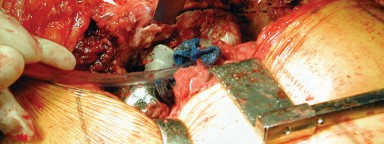 Illustration 19 for Achieving Success with Trochanteric Osteotomy Posterior for Revision