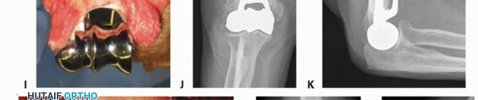 Illustration 29 for Distal Humeral Fractures: When Is Elbow Replacement the Best Option?