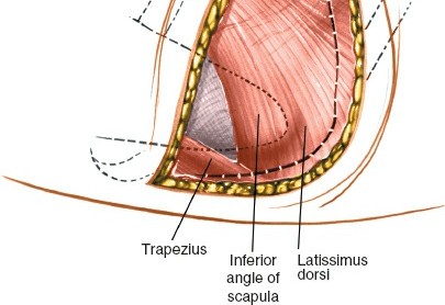 Illustration 311 for Approach to the Lumbar Spine: Mastering Techniques & Anatomy