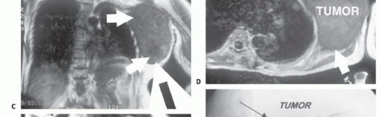 Illustration 16 for Limb-Sparing Resections Around the Shoulder: Optimizing Outcomes
