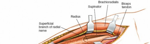 Illustration 18 for Radius Anterior Approach: Safe Nerve Protection & Complete Exposure