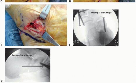 Illustration 23 for Lateral Column Lengthening: Relieve Flatfoot Pain & Correct Deformity