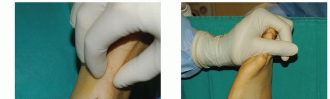 Illustration 3 for Restore Movement: Tendon Transfer for Common Peroneal Nerve Foot Drop