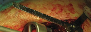 Illustration 47 for Figure Hip Resurfacing: Who Benefits and Who Should Avoid It?