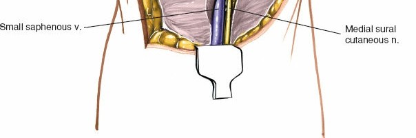 Illustration 179 for Mastering Knee Approaches: Spotlight on Superficial Medial Ligament