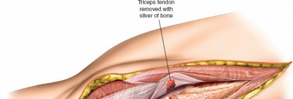 Illustration 19 for Mastering Elbow Approaches: Applied Surgical Anatomy for Precision