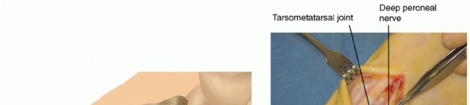 Achieve Lasting Results: Medial Capsular Closure in Revision Hallux Valgus