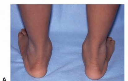 Illustration 3 for Calcaneal Lengthening Osteotomy: Correcting Hindfoot Valgus