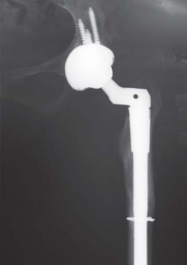 Illustration 36 for Successful Total Hip Replacement in Developmental Dysplasia