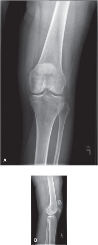 Real Case: Understanding Patellar Fractures Management