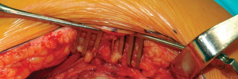 Illustration 45 for Direct Lateral Hip: Optimize Exposure with Sharp Curved Hohmann