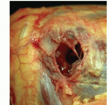 Illustration 5 for Radial Head & Neck Fractures: Mastering ORIF for Best Results