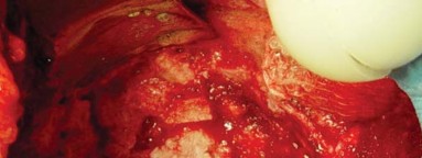 Illustration 25 for Expert Bone Grafting for Primary Total Hip Replacement Success