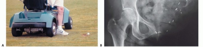 Illustration 29 for Posterior Flap Hemipelvectomy: Mastering Techniques for Optimal Outcomes