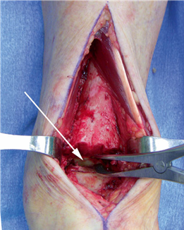 Illustration 8 for First Metatarsal Surgery: Expert Solutions for Foot & Ankle Pain