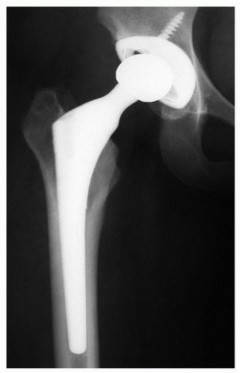 Illustration 9 for Why Double-Tapered Primary Stems Deliver Lasting Stability
