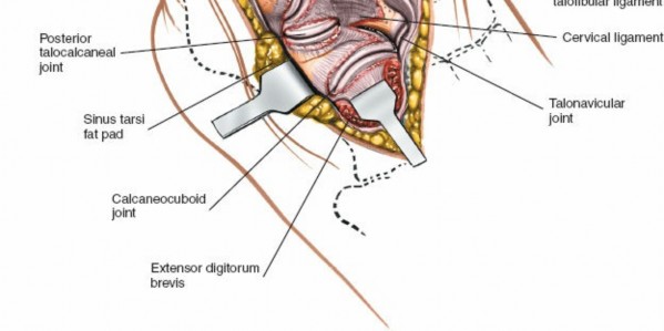 Illustration 100 for Optimized Approaches to the Dorsum of the Foot & Ankle
