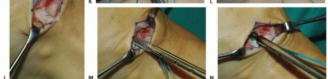 Illustration 21 for Restore Movement: Tendon Transfer for Common Peroneal Nerve Foot Drop