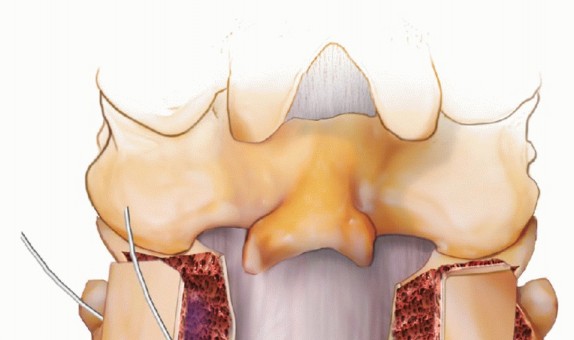 Illustration 16 for Achieve Stability: Posterior Cervical Lateral Mass Screw Fusion