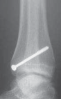 Illustration 27 for Pediatric Ankle Fractures: Management to Prevent Long-Term Issues