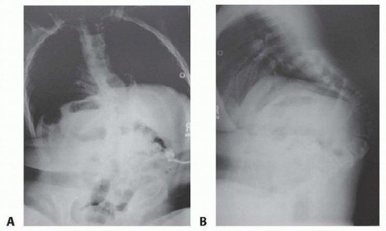 Kyphectomy in Spina: Preventing Life-Threatening Complications