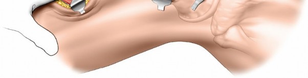 Illustration 58 for Optimal Femoral Approaches: Mastering the Lateral Intermuscular Septum