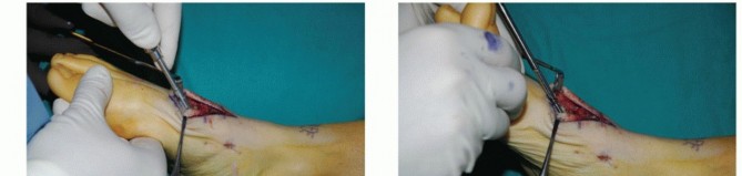 Illustration 23 for Mastering Midfoot Arthrodesis: Protect the Deep Neurovascular Bundle