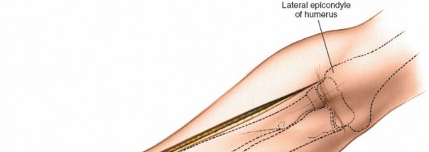 Illustration 2 for Radius Anterior Approach: Safe Nerve Protection & Complete Exposure
