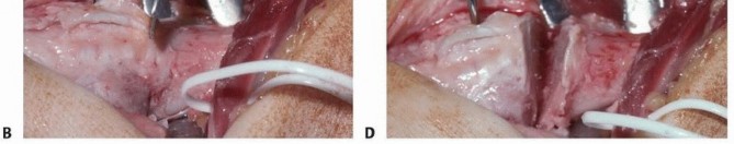 Illustration 16 for Precision Correction for Distal Radius Malunion