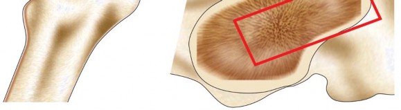 Illustration 12 for Mastering Cementing Technique Femur: A Step-by-Step Guide