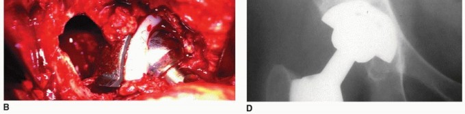 Illustration 7 for Osteolysis Solved: Polyethylene Liner Exchange for Well-Fixed Components
