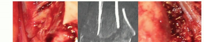 Illustration 19 for Distal Humeral Fractures: When Is Elbow Replacement the Best Option?