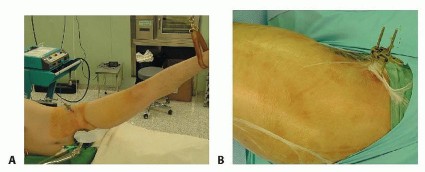 Illustration 21 for Hip Resurfacing: The Bone-Sparing Solution around the Femoral Head