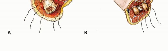 Illustration 24 for Above-Elbow & Below-Elbow Amputations: When & Why They're Needed