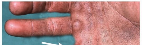 Surgical Treatment of Injection Injuries in the Hand