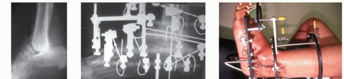 Illustration 27 for Beyond Amputation: Circular Fixation for Infection of the Talus