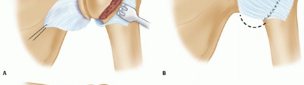Illustration 19 for Finally Treat Recurrent Posterior Instability of the Shoulder