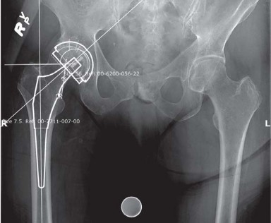 Approaches Posterolateral Surgical: A Guide to Enhanced Hip Surgery