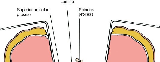 Illustration 179 for Approach to the Lumbar Spine: Mastering Techniques & Anatomy