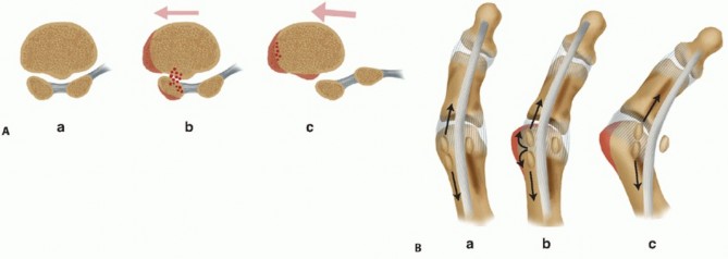Illustration 3 for Optimizing Internal Fixation of Sesamoid Fractures