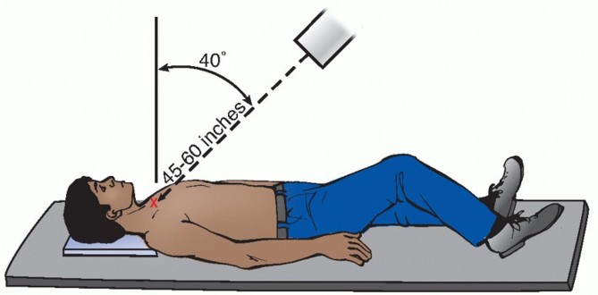 Illustration 7 for Optimizing SC Dislocation Repair After Medial Clavicle Resection