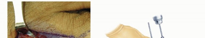 Illustration 19 for Effective K-Wire Fixation: Distal Radius Fractures Without External Fixation