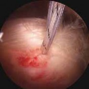 Illustration 11 for Resolve Long Head Biceps Pain: Advanced Arthroscopic Treatment
