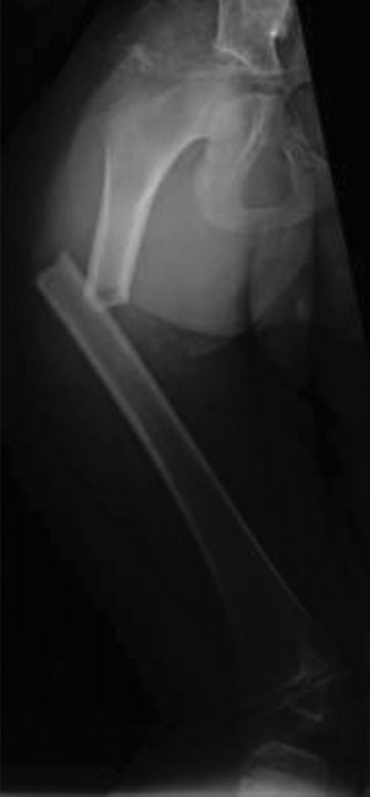 Pediatric Cases: Optimal Closure of the Distal Femur