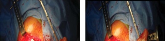 Illustration 7 for The Proxima: Why This Proximally Loading Implant Preserves Bone