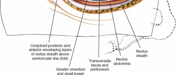 Illustration 17 for Expert Guide: Transperitoneal and Retroperitoneal Lumbar Access